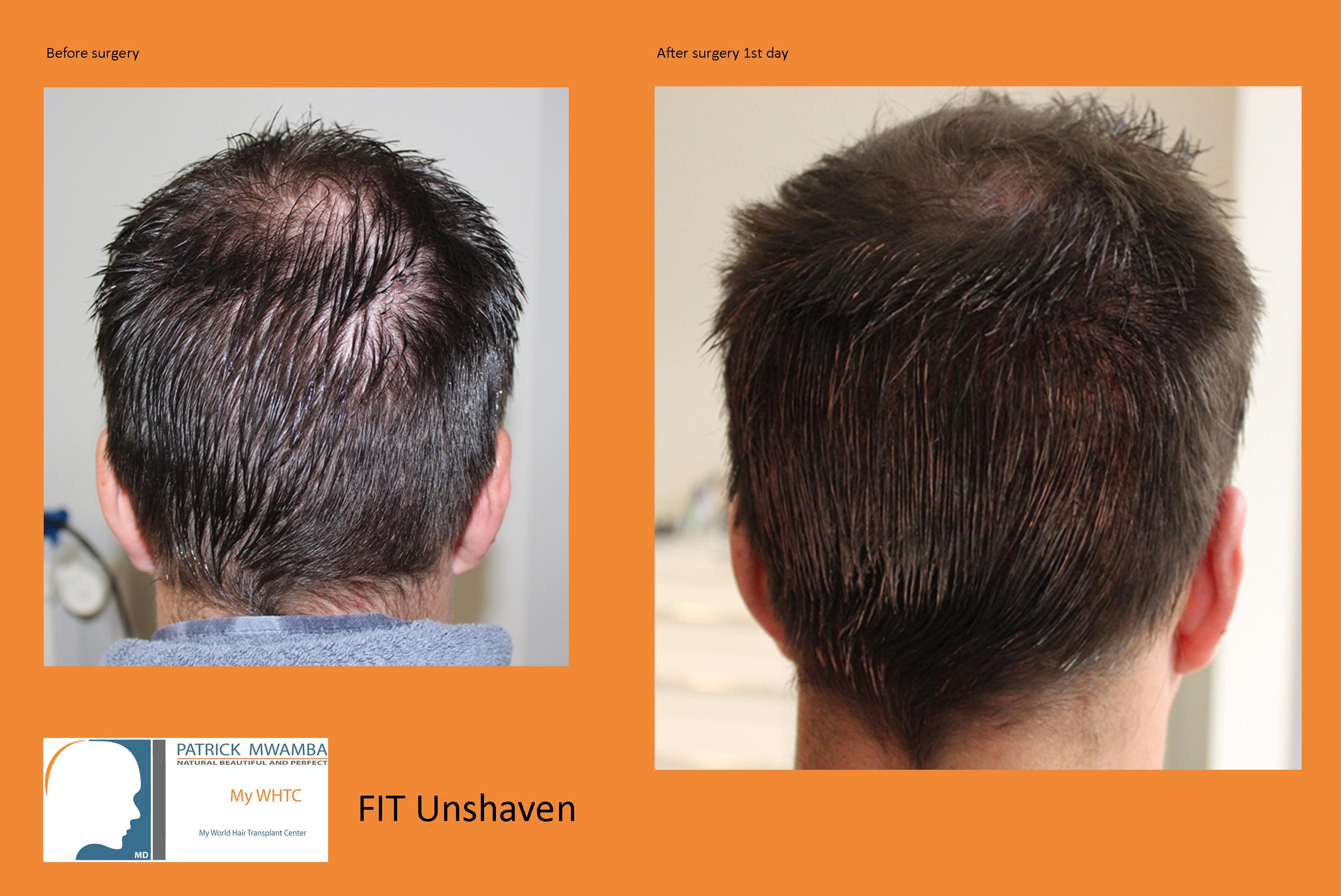 Beispiel Entnahmebereich nach einer FUE Haartransplantation ohne Rasur 