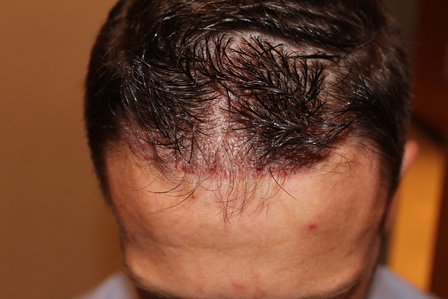 Haartransplantation ohne Rasur - rasieren Beispiel Empfangszone