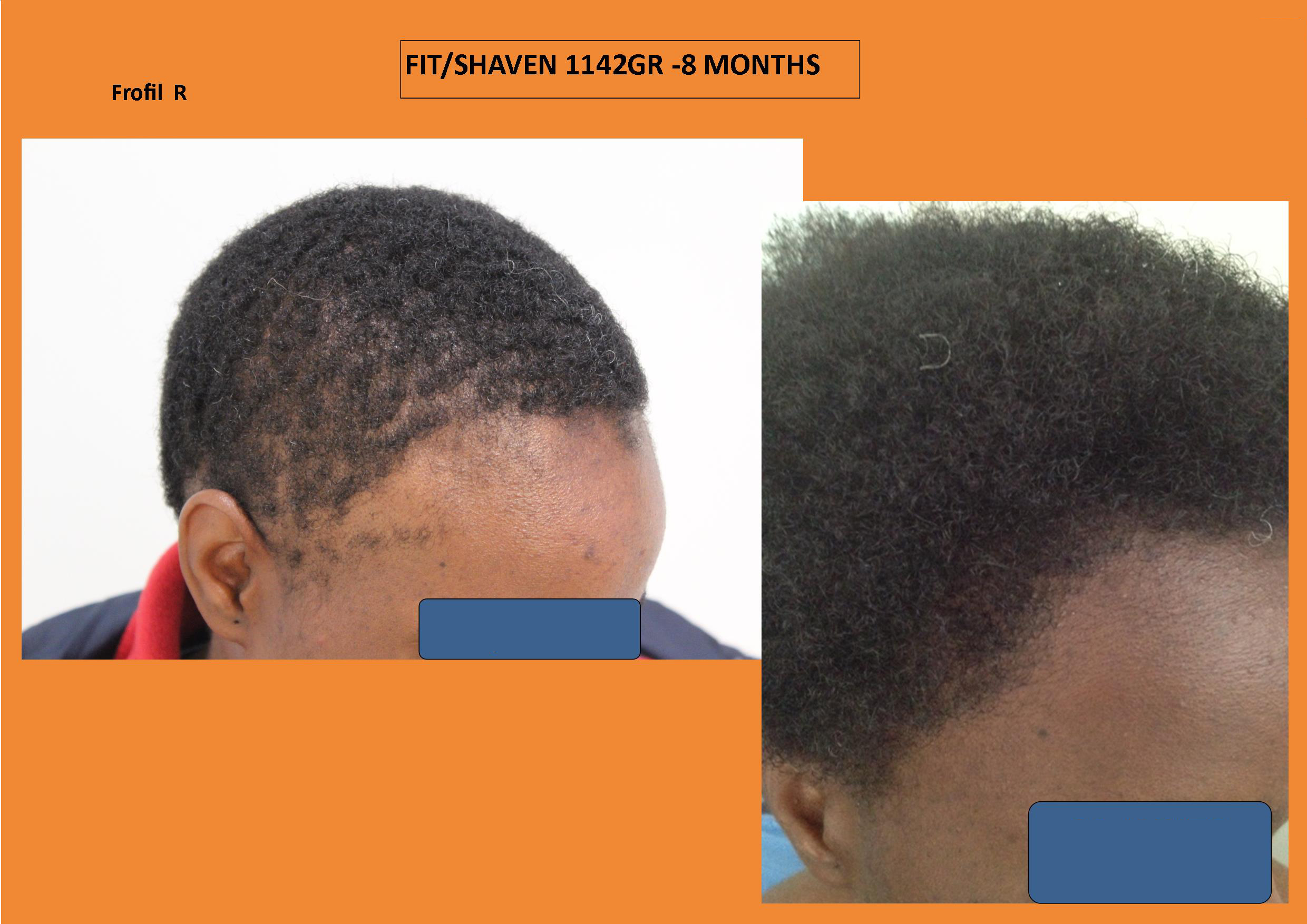 Afrikaner - Africans Haartransplantation Resultat rechts