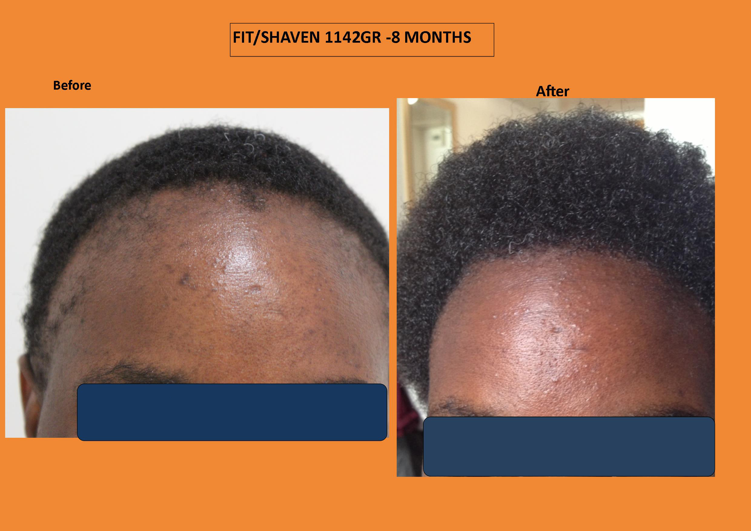 Afrikaner - Africans Haartransplantation Vorher/Nachher Vergleich