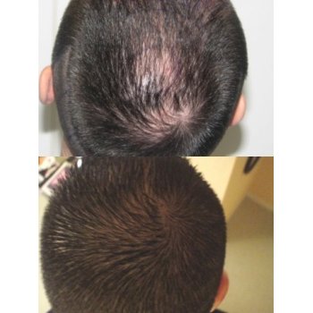 Result Tonsure