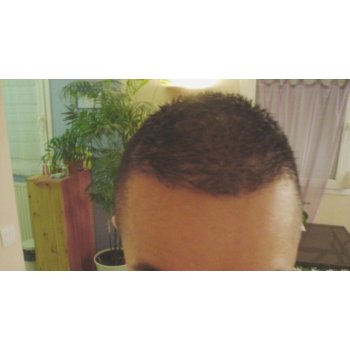 Result Hairline 2