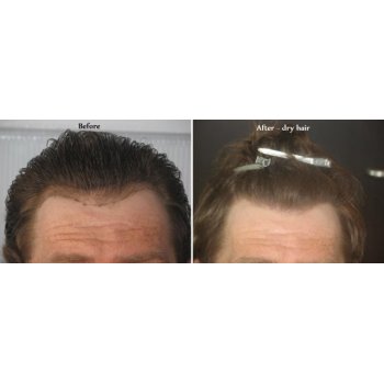 Before and after dry hairs 1